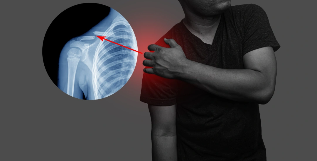 ACL Reconstruction surgery